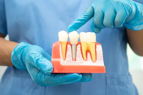 Dental Implant Restorations